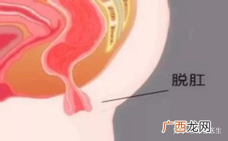 肛门口有个软软的肉疙瘩是什么,肛门口有个软软肉凸起是怎么回事?