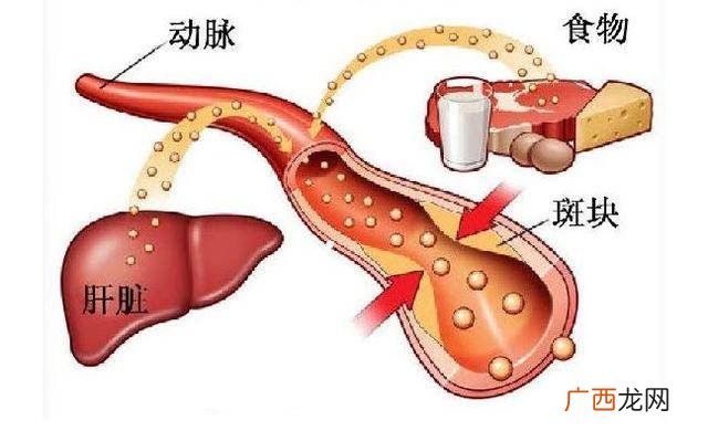 什么是胆固醇高,高胆固醇的症状有哪些？