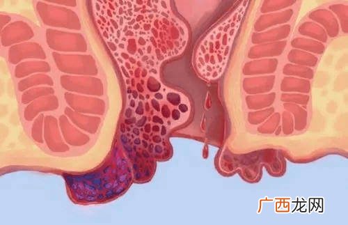 怎么消除痔疮小肉球,痔疮小肉球怎么去掉？