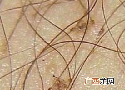 为什么要长阴虱呢,什么是阴虱，阴虱是什么引起的？