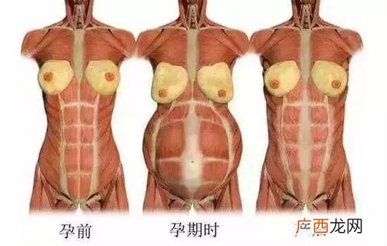 腹直肌分离是什么意思,产后腹直肌分离一到半指？
