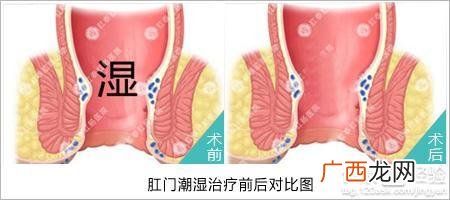 肛门潮湿瘙痒是怎么回事,肛门又湿又痒怎么办？