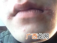 嘴巴周围长痘痘是什么原因引起的,嘴巴一圈长痘痘是什么原因引起的？