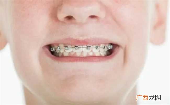 建议不要随便整牙是为什么 为什么建议不要随便整牙