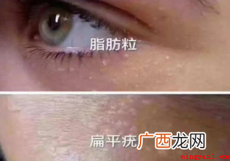 眼下颗粒怎么办 最好的办法还是去医院找专业医生处理