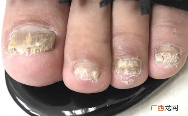 怎么判断灰指甲想要鉴别 如何鉴别灰指甲严重程度