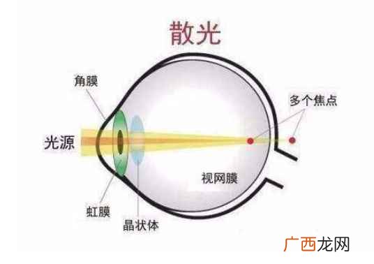 散光与近视的区别是什么 100度散光等于几度近视