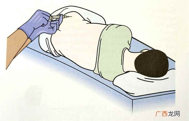 提取人体组织液检查化验的一种方法 穿刺检查