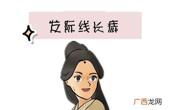 发际线有痣命运图解 女生左边发际线有痣富甲一方