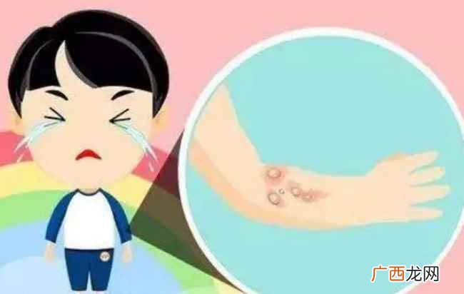 水泡不挑破会自己消吗