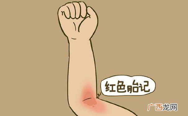 右手臂有胎记最有福气 右手臂有胎记寓意是什么
