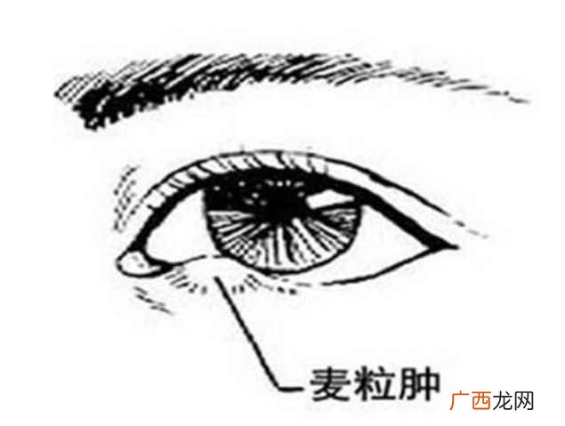 麦粒肿患者需要注意什么 麦粒肿可以自己消退吗