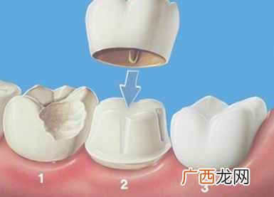 烤瓷牙套里的牙会烂吗怎么治 烤瓷牙套里的牙会烂吗