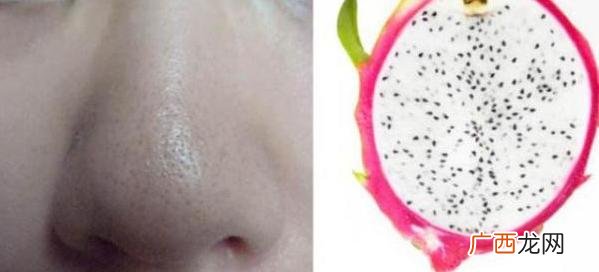 黑头怎么去除最有效 黑头是怎样产生的