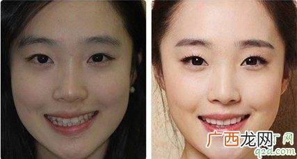牙齿错位咬合怎么办隐形矫正技术 牙齿错位有什么危害
