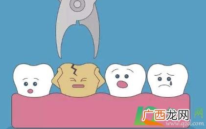 拔了四颗智齿多久才可以正常吃饭 有四颗智齿一定要全部拔吗