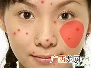 左脸颊长痘的原因 左脸颊长痘是什么原因