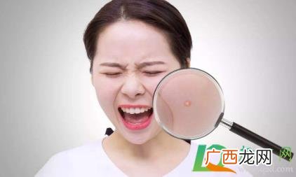 湿气重是不是容易长痘 湿气重有什么症状会长痘吗