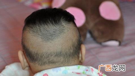 婴儿枕秃是缺钙吗 枕秃是缺钙吗