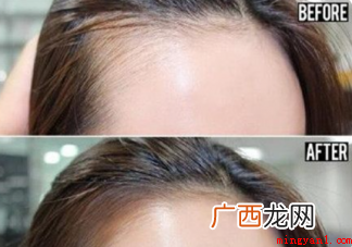 二十六岁发际线特别高怎么办 怎么解决提前秃顶的问题