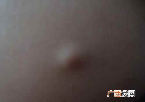 脂肪瘤是怎么形成的 脂肪瘤里面是什么东西,脂肪瘤切开是什么
