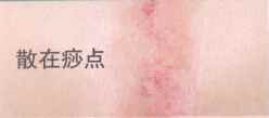 刮痧后背部颜色判断图片解析 刮痧后背部颜色判断图片