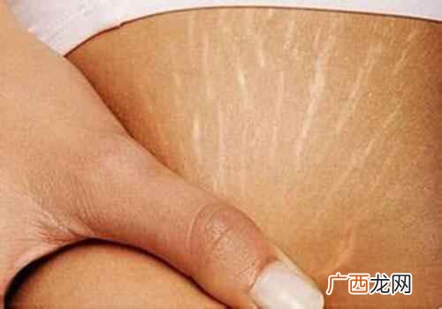 激光治疗激光去除膨胀纹 膨胀纹怎么消除,膨胀纹怎么去掉