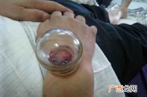 手臂拔罐的正确位置图 手臂拔罐位置示意图