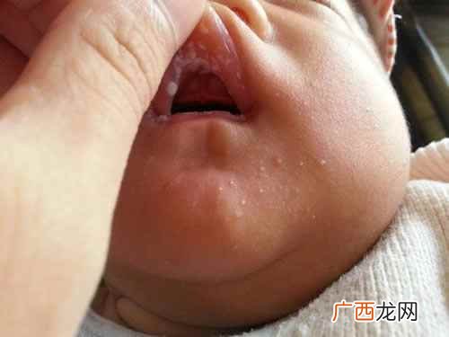 小儿鹅口疮的症状表现 小儿鹅口疮的症状