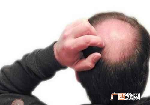 种植头发有什么危害 种植头发有什么害处