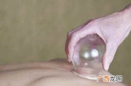 头疼拔罐拔哪里最有效图片 头疼拔罐拔哪里最有效