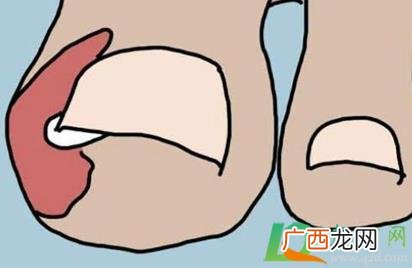 甲沟炎肿了用碘伏行吗 甲沟炎如何自己处理