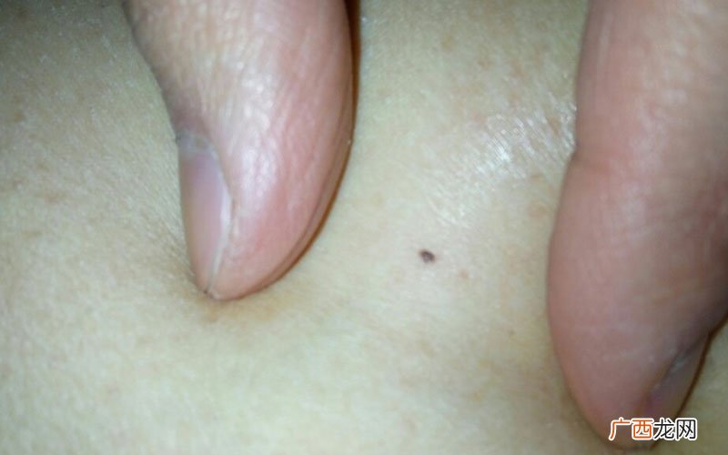 大腿内侧有痣财运旺 大腿根内侧有痣代表什么