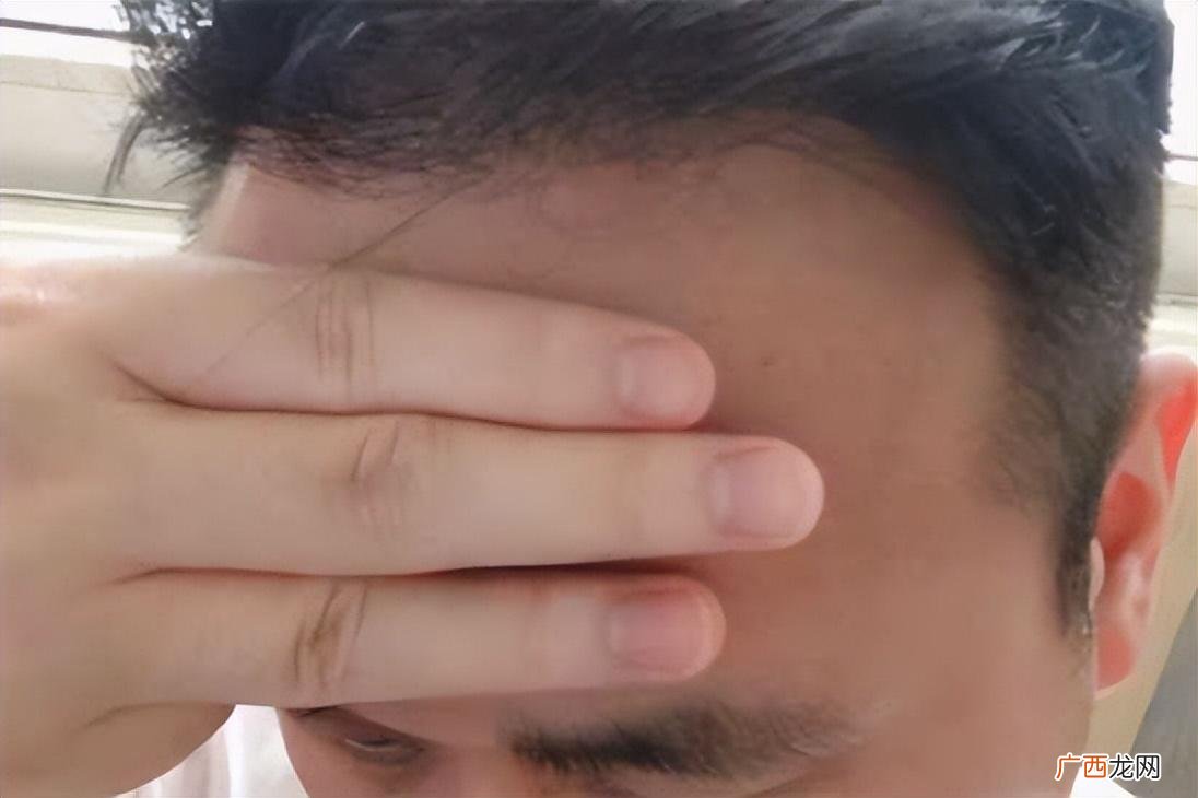 正常发际线在哪个位置 标准发际线是几指宽