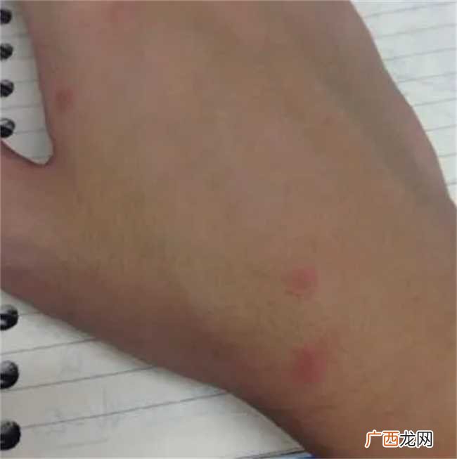 被蚊子咬了留下疤痕吗 被蚊子咬了会不会留疤