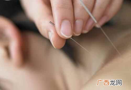 穴位埋线减肥前要注意什么选正规医院 埋线减肥要注意什么,埋线减肥后注意事项