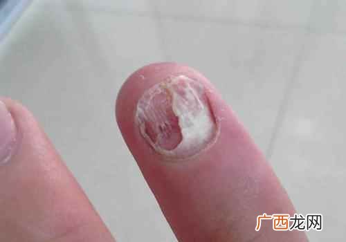 指甲脱落是什么原因引起 指甲脱落是什么原因