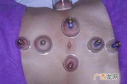 收腹祛脂的穴位有哪些 拔罐拔哪里可以减肚子,正确拔罐减肚子图