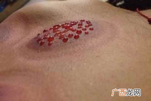 体内火毒引起拔罐后身上后背发痒 拔罐后身上后背持续发痒怎么回事
