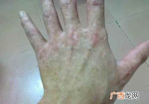 手背长斑是什么原因 手背长斑是什么原因造成的