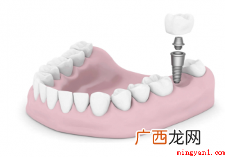 为什么种植牙费用这么高
