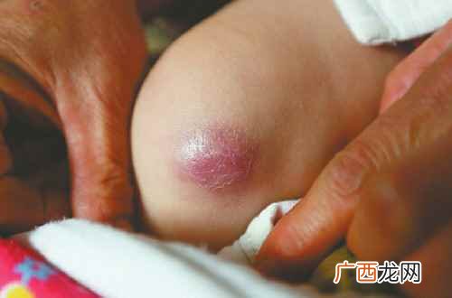 麻风疫苗不良反应有哪些 麻风疫苗不良反应