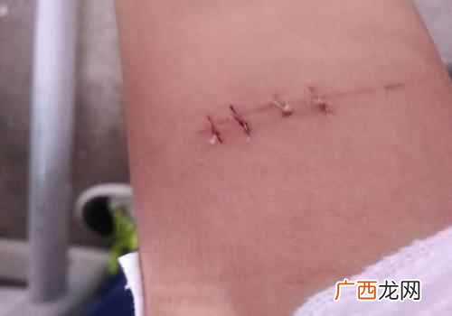 伤口拆线后多久可以运动 拆线后多久可以运动
