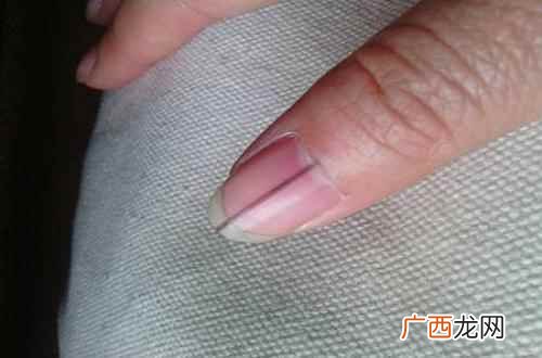大拇指指甲有竖纹黑线是怎么回事 指甲里有黑线竖纹是怎么了