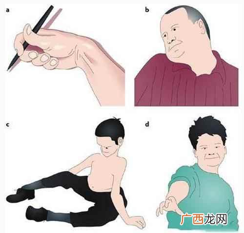 小舞蹈病患者可出现哪些精神症状 小舞蹈病