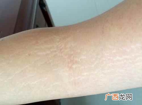 大腿内侧出现红色条纹干疼 大腿内侧有红色条纹是怎么回事