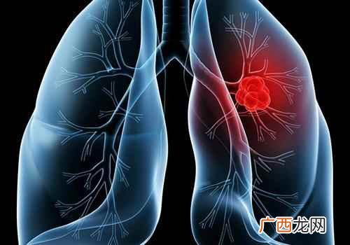 肺癌的早期症状有哪些预兆 肺癌的早期症状有哪些