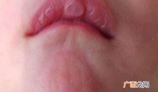 婴儿嘴唇有白点是什么原因 宝宝嘴唇有白点怎么回事