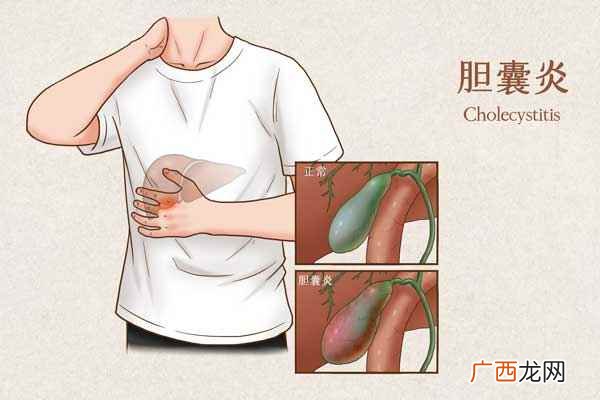 胆囊炎患者应保持清淡饮食的原则 哪些东西胆囊炎不能吃