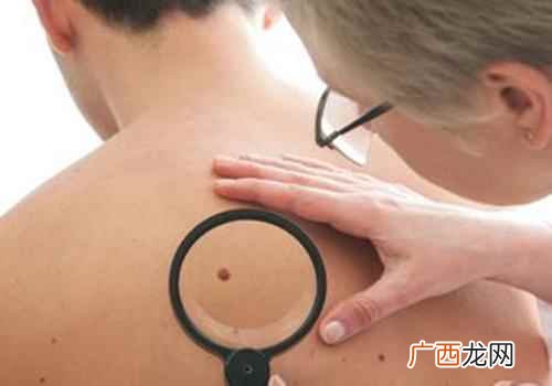 脸上的痣都有啥含义 痣的含义